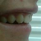 Dental Implants - West Dental Clinic