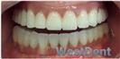 Dental Implants - West Dental Clinic