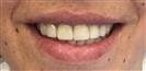 Dental Implants - West Dental Clinic