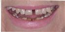 Dental Implants - West Dental Clinic
