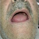 Dental Implants - West Dental Clinic