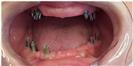 Dental Implants - West Dental Clinic