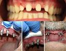 Dental Implants - West Dental Clinic