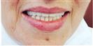 Dental Implants - West Dental Clinic
