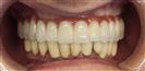 Dental Implants - West Dental Clinic