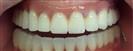 Dental Implants - West Dental Clinic