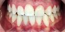 Dental Implants - West Dental Clinic