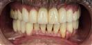 Dental Implants - West Dental Clinic