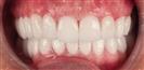 Dental Implants - West Dental Clinic