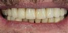 Dental Implants - West Dental Clinic