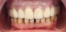 Dental Implants - West Dental Clinic