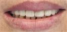Dental Implants - West Dental Clinic