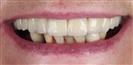 Dental Implants - West Dental Clinic