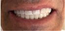 Dental Implants - West Dental Clinic