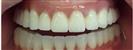 Dental Implants - West Dental Clinic