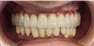 Dental Implants - West Dental Clinic