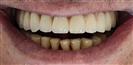 Dental Implants - West Dental Clinic