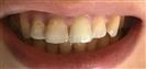 Dental Implants - West Dental Clinic