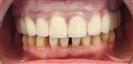 Dental Implants - West Dental Clinic