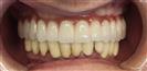 Dental Implants - West Dental Clinic
