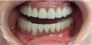 Dental Implants - West Dental Clinic