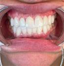 Dental Implants - West Dental Clinic