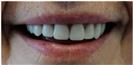 Dental Implants - West Dental Clinic