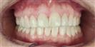Dental Implants - West Dental Clinic