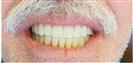 Dental Implants - West Dental Clinic