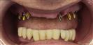 Dental Implants - West Dental Clinic