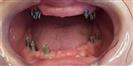 Dental Implants - West Dental Clinic