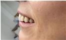 Dental Implants - West Dental Clinic