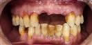 Dental Implants - West Dental Clinic