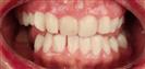 Dental Implants - West Dental Clinic