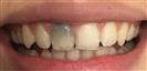 Dental Implants - West Dental Clinic
