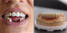 Dental Implants - West Dental Clinic