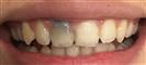 Dental Implants - West Dental Clinic
