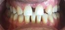 Dental Implants - West Dental Clinic