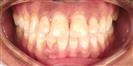 Dental Implants - West Dental Clinic