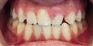 Dental Implants - West Dental Clinic