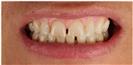Dental Implants - West Dental Clinic