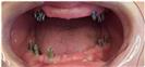 Dental Implants - West Dental Clinic