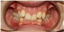 Dental Implants - West Dental Clinic