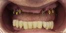 Dental Implants - West Dental Clinic