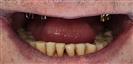 Dental Implants - West Dental Clinic