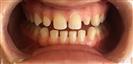 Dental Implants - West Dental Clinic