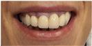 Dental Implants - West Dental Clinic