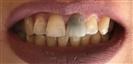Dental Implants - West Dental Clinic