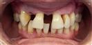 Dental Implants - West Dental Clinic