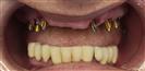 Dental Implants - West Dental Clinic